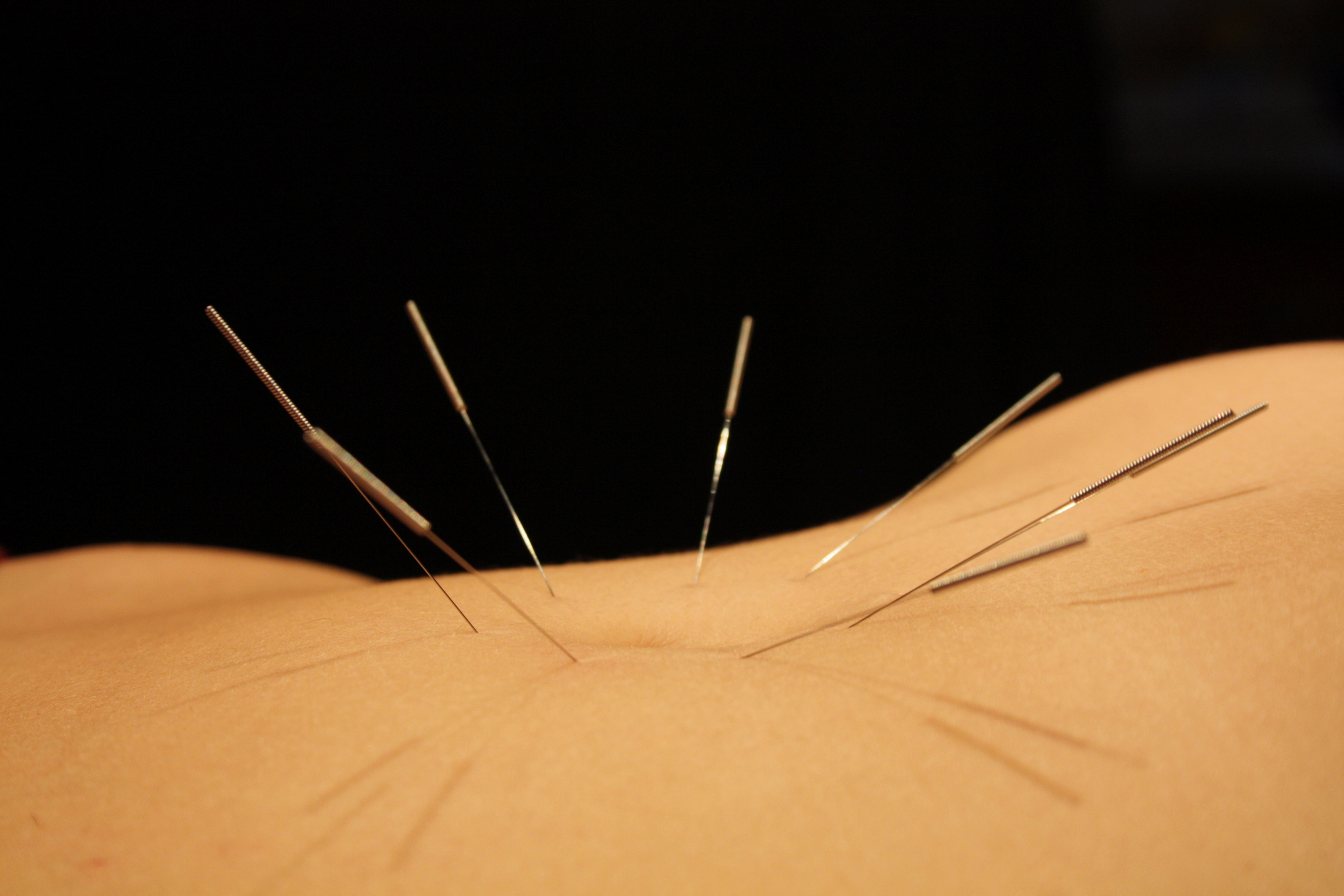Steriele acupunctuurnaalden
